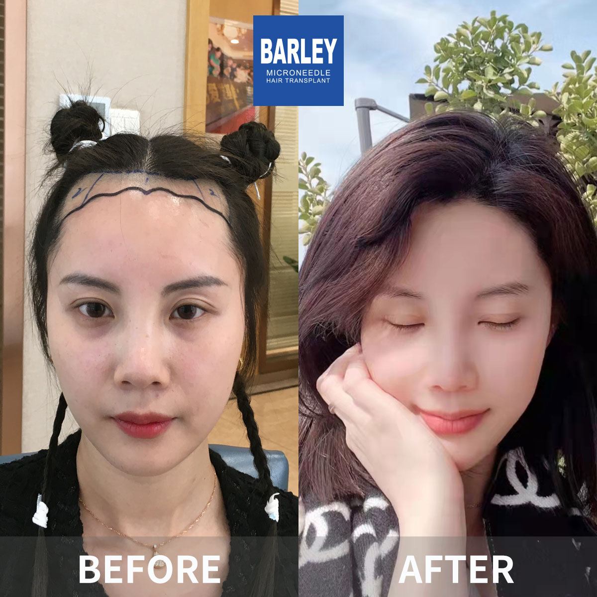 Women's Hairline Transplant Result