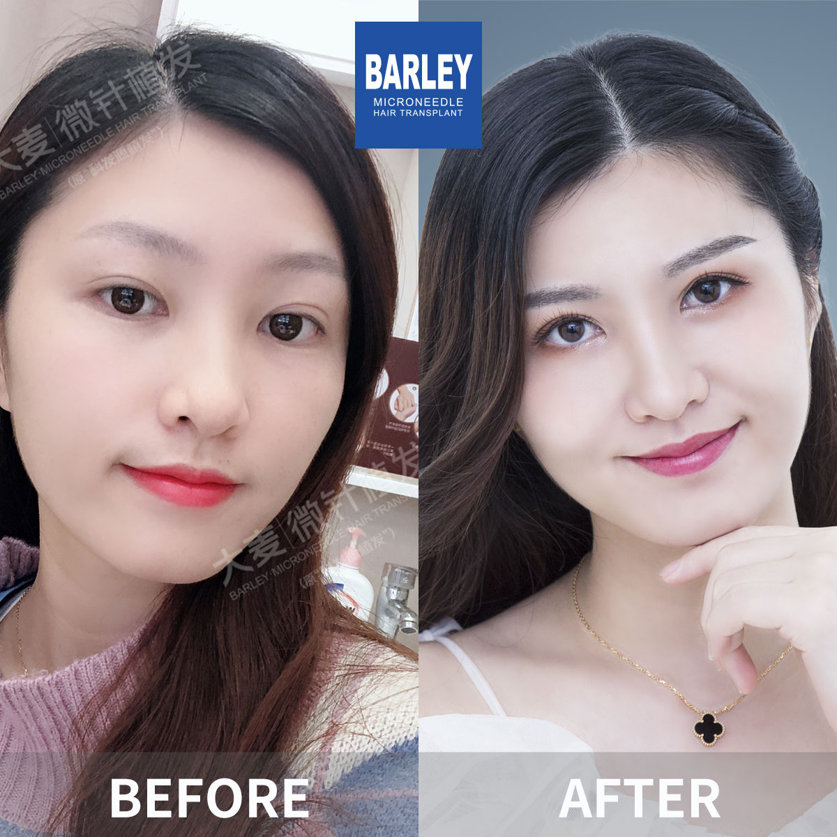 Women's Hairline Transplant Result