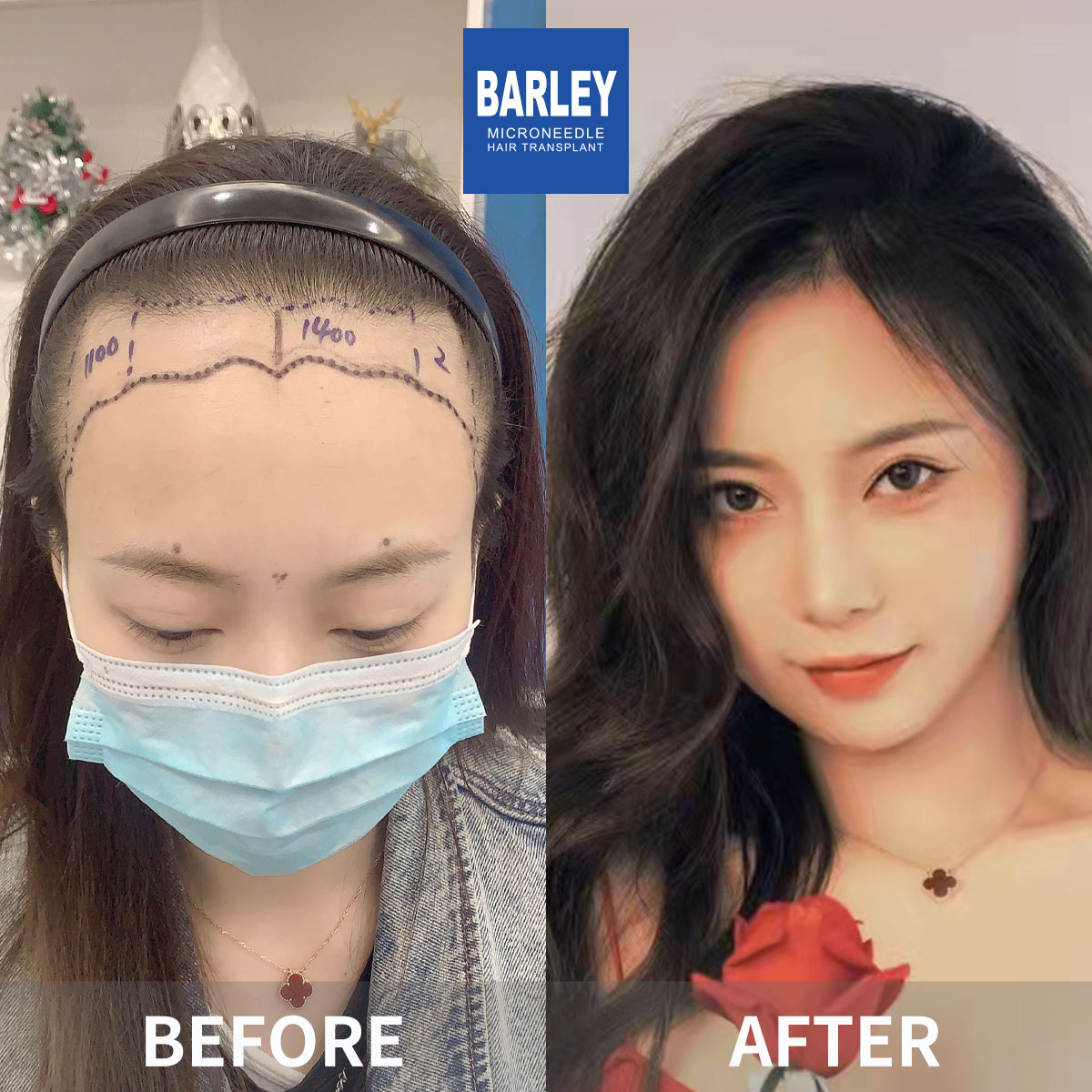 Women's Hairline Transplant Result