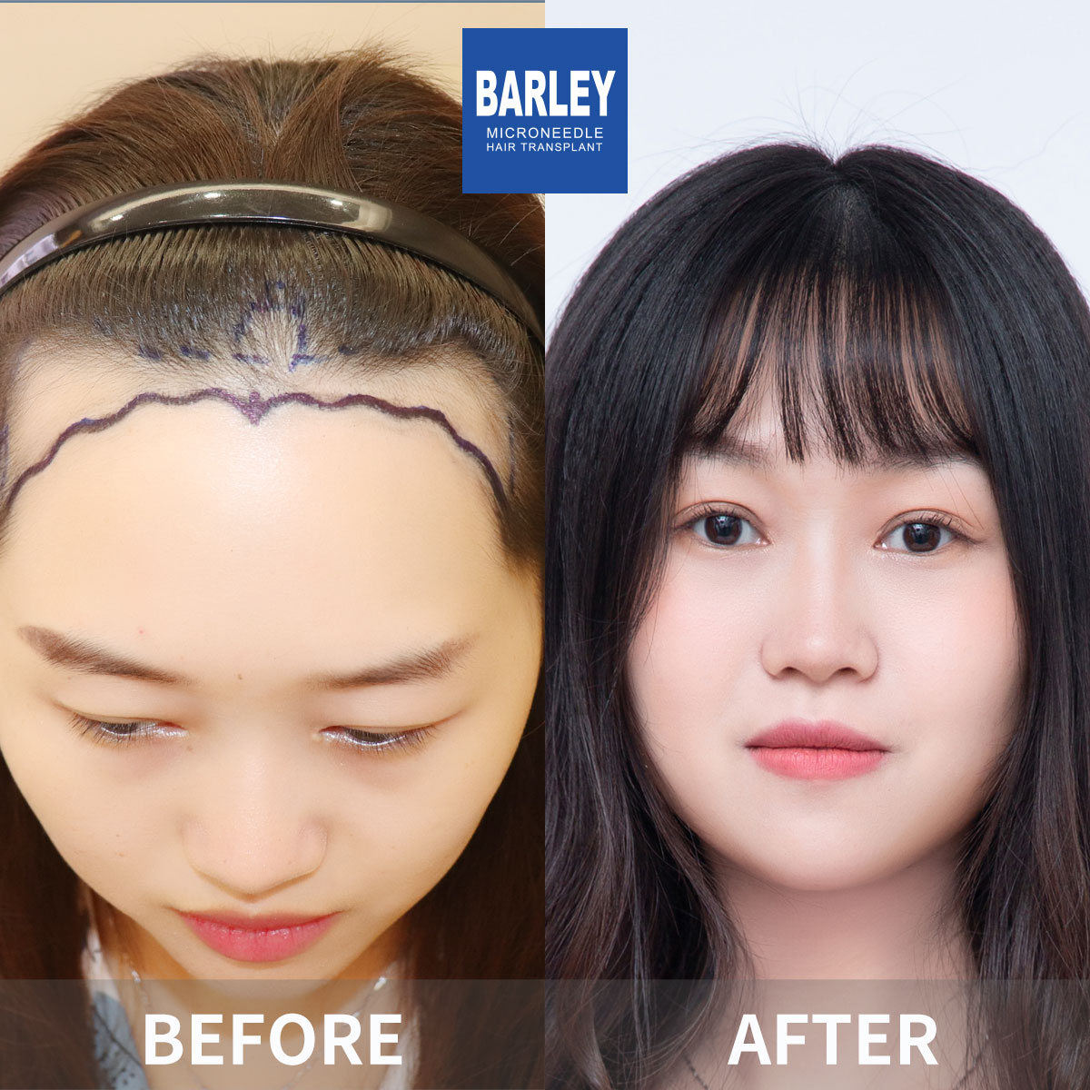 Female Hair Thickening