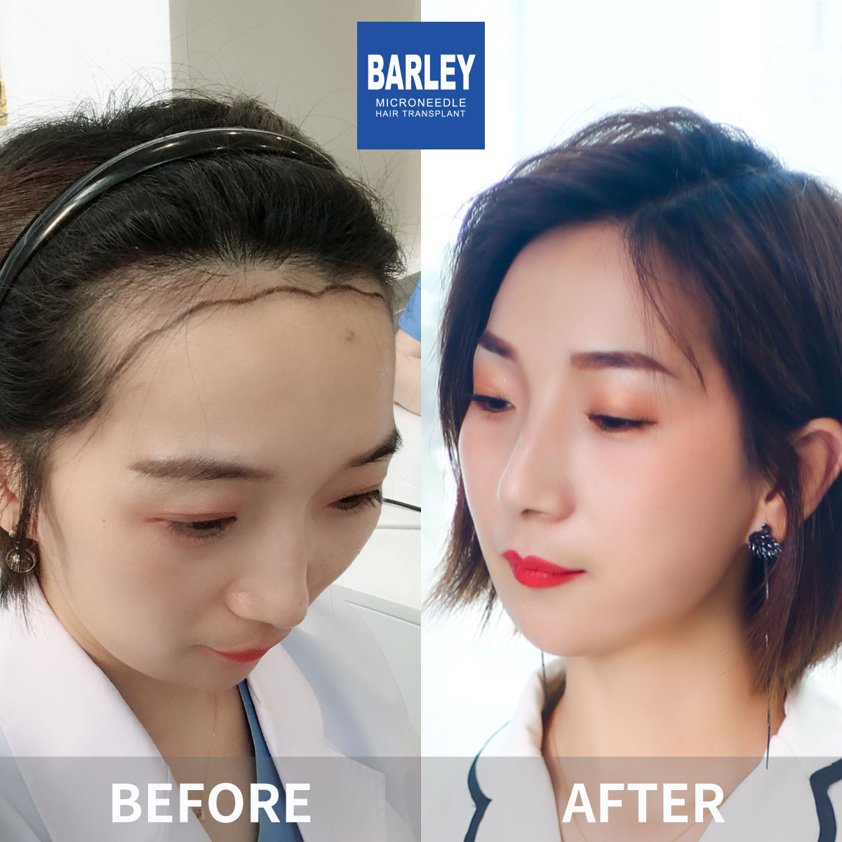Women's Hairline Transplant Result
