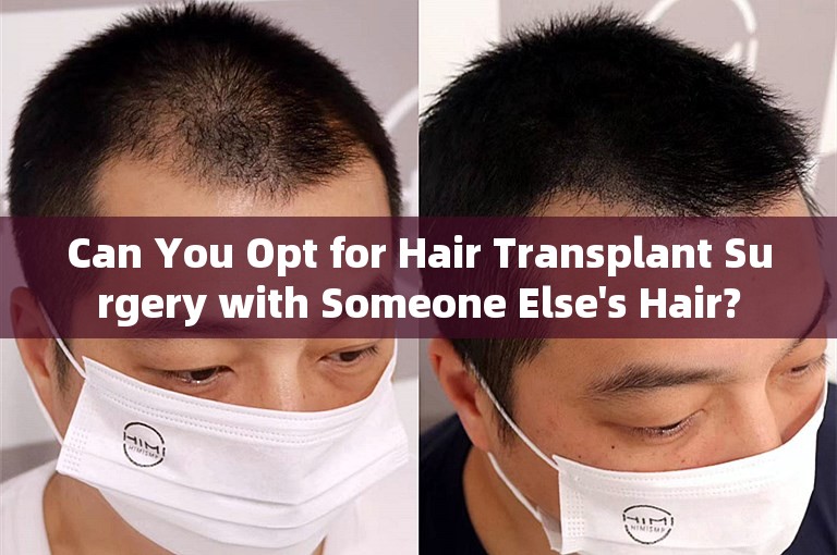 Can You Opt for Hair Transplant Surgery with Someone Else's Hair?