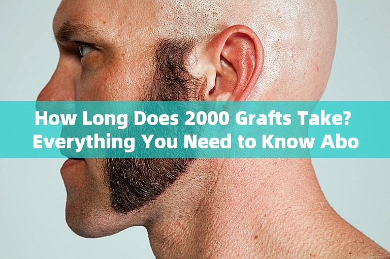 How Long Does 2000 Grafts Take? Everything You Need to Know About Hair Transplant
