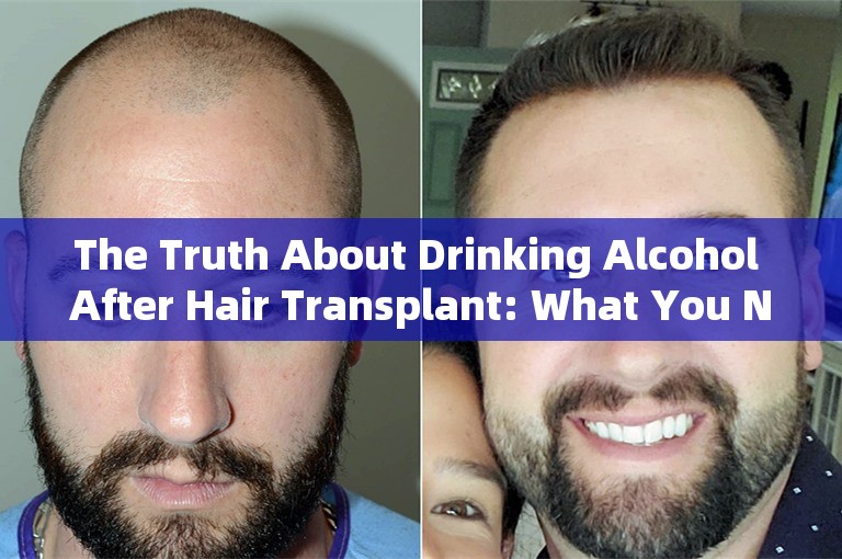 The Truth About Drinking Alcohol After Hair Transplant: What You Need To Know