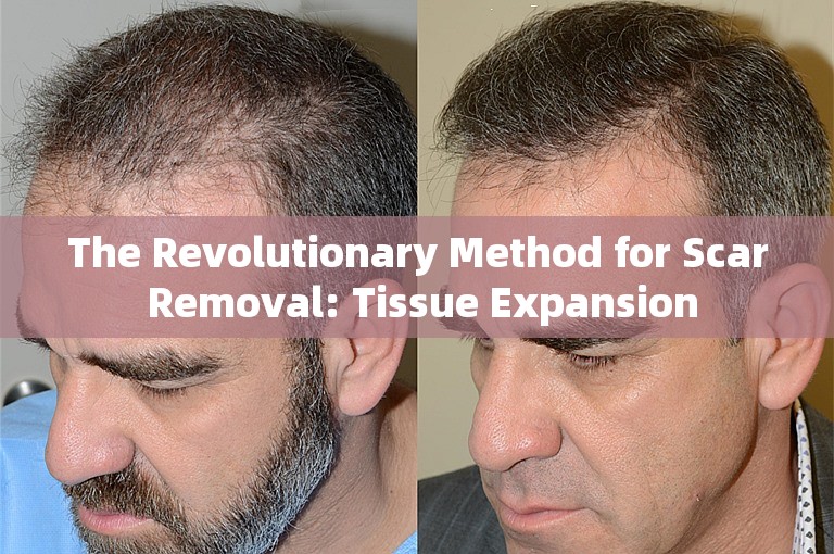 The Revolutionary Method for Scar Removal: Tissue Expansion
